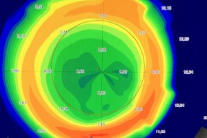 mappa_corneale